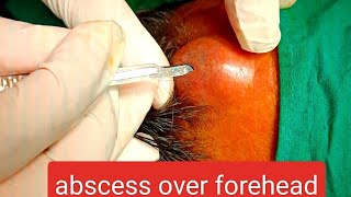 abscess over forehead  infected cyst over forehead  incision n drainage youtube dr doctor [upl. by Reseda942]