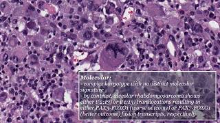 Pleomorphic Rhabdomyosarcoma [upl. by Ime156]