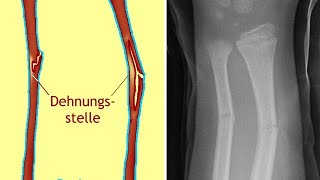 Grünholzfraktur Ursachen Diagnose und Behandlung [upl. by Lukasz]