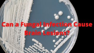 Can A Fungal Infection Cause Brain Lesions [upl. by Weinshienk]