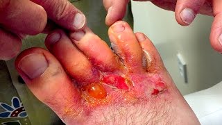 HORRIBLE FOOT RASH Infection  Dr Paul [upl. by Tressa]