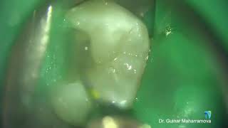 Acute Apical Periodontitis Nonsurgical Root Canal Treatment [upl. by Ahsaf]