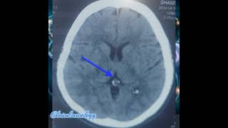 Pineal gland calcification on CT brain plain pineal glands ct brain neurology [upl. by Pepin]