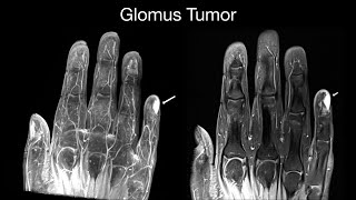 Glomus Tumor [upl. by Svend593]