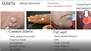 Warts causes and treatment Wart Types [upl. by Nivlem]