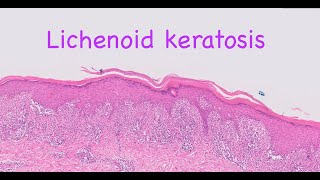 Lichenoid keratosis [upl. by Solraced]