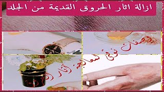 علاجاثارالحروق اعملي بنفسك مرهم لعلاج الحروق والبقع الداكنه والتخلص من الاسمرار والكلف [upl. by Atsyrc]