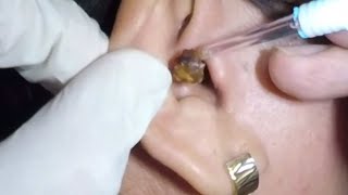 Womans Massive Earwax Removal in Both Ears [upl. by Neiviv578]