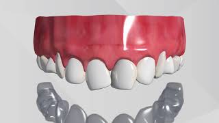 Invisalign 3D Animation [upl. by Novelia]