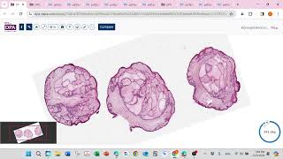 Basel cell carcinoma and pinkus variant [upl. by Liebman704]