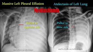 pleural effusion vs atelectasis [upl. by Nomzed]