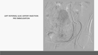 Preoperative sacral tumor embolisation [upl. by Ennavoj54]