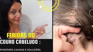 Herpes labial – Dr Paulo Müller Dermatologista [upl. by Siddon]