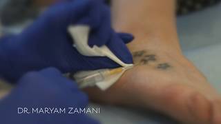 Plexr for Tattoo Removal  Dr Maryam Zamani [upl. by Nagy]