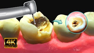 Caries GIGANTE con HONGOS en 4k  Tratamiento de conducto [upl. by Lolita]