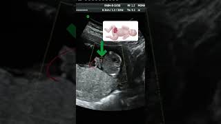 Its a baby girl but there is a propblem  GASTROSCHISIS  Ultrasound [upl. by Terej546]