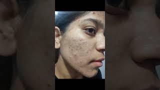 2 month complete tretinoin cream 0025 face tretinoin skincare tretinoincream darkspots face [upl. by Nickie688]