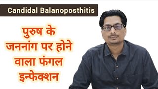 Candidal Balanoposthitis  पुरुष के अंग पर होने वाला फंगल इन्फेक्शन  Fungal infection candida [upl. by Skeie]