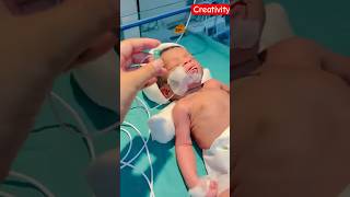 Newborn baby orogastric Tube Feeding video nicu medical viral [upl. by Ahsyen]