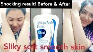 Prevent Itching prickly heatEczemaAcne ampGet smooth Skin with OILATUM EmollientBeforeafter review [upl. by Arlyne]