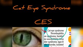 Cat Eye Syndrome CES chromosome 22 aberration In English [upl. by Mohandas195]