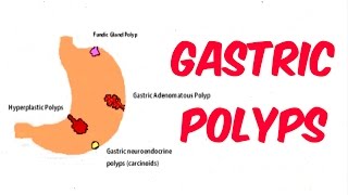 Gastric Stomach Polyps [upl. by Teik]