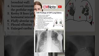 Chest X Ray of Lung Edema medical doctor nursing [upl. by Anayhd]