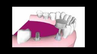 How to customize a standard abutment for GCuff™ implant impression [upl. by Campy]