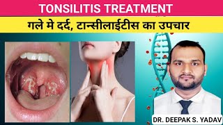 TONSILITIS CAUSES SINGS amp SYMPTOMS TREATMENT tonsillitis treatmentoftonsilitis [upl. by Oninotna170]