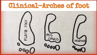 Arches of Foot  Clinical Anatomy [upl. by Immac]