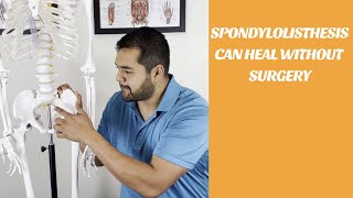 Lower Back Pain Spondylolisthesis Can Heal Without Surgery  El Paso Manual Physical Therapy [upl. by Isherwood]