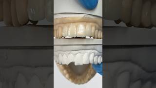 Working to replace a chipped tooth ​⁠EnvisiontecMain envisiontec lsk121shorts dentist teeth [upl. by Okin]