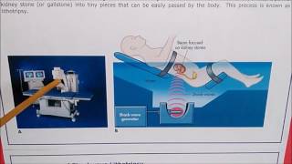 Lithotripsy  Ellipse in medical application [upl. by Anihcak135]