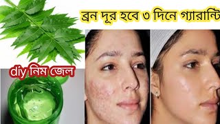 I applied👆🏻this DIY Neem Gel on Acne Pimples PigmentationBumps  Got Clear Glowing Skin In 3 Days [upl. by Gschu]