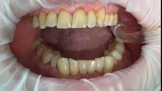 Dentistry  Scale Polish amp Tepe brushing ASMR [upl. by Bussy172]