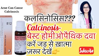 Calcinosis कल्सिनोसिसकलसियम का ज़्यादा होनाHomeopathyBest Treatment By DrRukmani Choudhary [upl. by Elok]