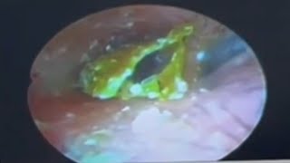 TRICKY EAR WAX REMOVAL BY CURETTAGE earwax Cleaning earwaxremoval satisfying lullaby [upl. by Ezirtaeb124]