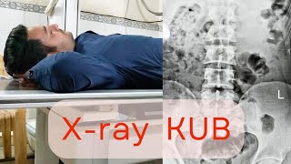 Xray KUB Positioning  Exposure  Measurements Digitising And Printing [upl. by Hnoj]