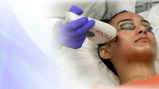 Moxi Laser Treatment  Maffi Clinics [upl. by Klotz]