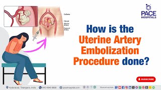 How is the Uterine Artery Embolization Procedure done  uterinearteryembolization [upl. by Nelloc]