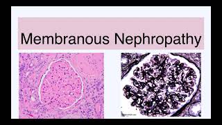 Membranous nephropathy [upl. by Llehcor]