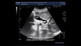 A Stone in the Bile duct called Choledocholithiasis [upl. by Oeniri]