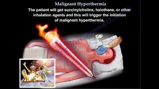 Malignant Hyperthermia  Everything You Need To Know  Dr Nabil Ebraheim [upl. by Lorinda]