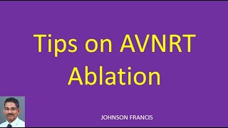 Tips on AVNRT Ablation [upl. by Von957]