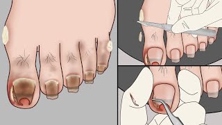 ASMR Ingrown Toenail Removal Treatment AnimationStrong Satisfaction  Mengs Stop Motion [upl. by Prissie]