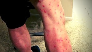 One Year Without Cosentyx and my Psoriasis is BACK [upl. by Attenaej]