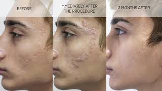 Acne scar subcision and filler [upl. by Atteniuq]