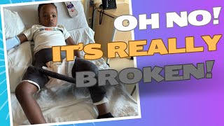 How Our toddler fractured his femur boneSpica Cast [upl. by Perrin]