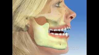 TMJ  Temporomandibular joint dysfunction [upl. by Aneerbas]