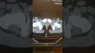 ctscan ct pelvic scan all details are provide in this video so watching the videos ctet [upl. by Nonnaehr]